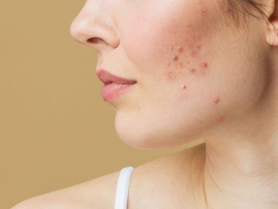acne-treatment-secunderabad