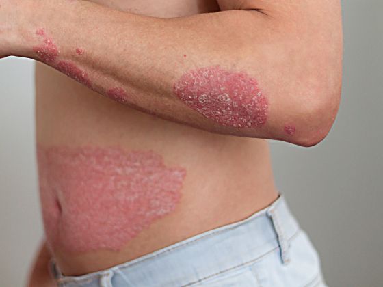 psoriasis-treatment-SD Road-Secunderabad