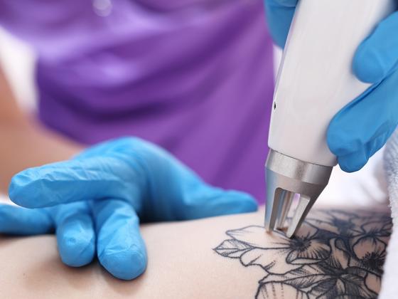 Laser Tattoo Removal | Cosmetic Dermatology & Laser Center | Michigan  Medicine | University of Michigan